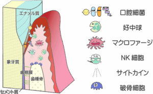 歯ぐきと免疫細胞を描いたイラスト