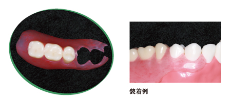 入れ歯装着例