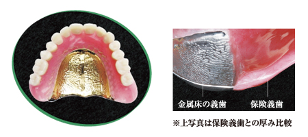 画像：使用感重視の義歯